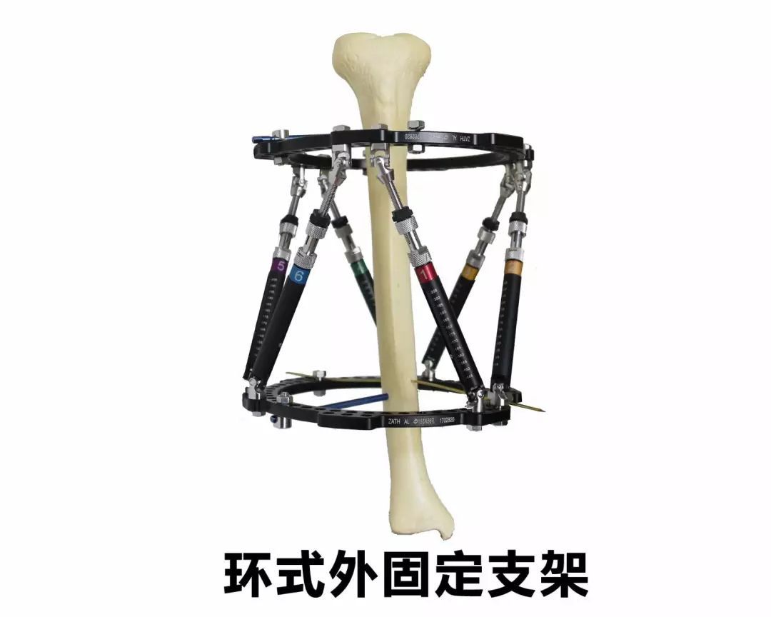 『8分钟创伤』胫骨干骨折：Ilizarov外固定架的应用及手术技巧 - 上海开为医药科技有限公司--创伤、肢体矫形技术解决方案的专业服务商