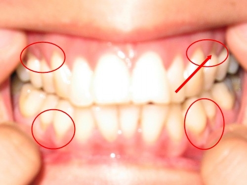 牙根颈图片